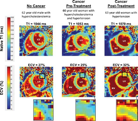 lv t1|ecv t1 mapping guidelines.